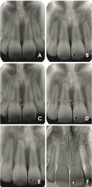 Fig. 2.  External apical root resorption is evaluated by the measure- measure-ment of the long axis of the maxillary central incisors at baseline (A,  Image 1) and in the registered image (B, Image 3).