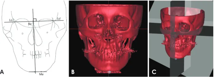Fig. 1.  Menton deviation as measured on the posteroranterior (PA) cephalogram (x 1 ) and three-dimensional computed tomography (3D  CT) (x 2 ) of one patient