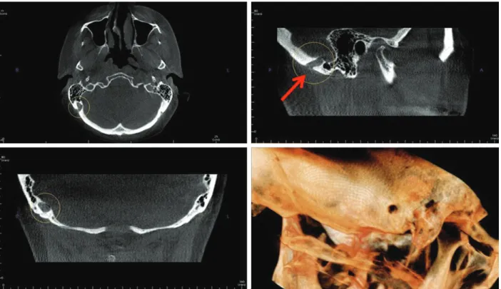 Fig. 3.  Cone beam CT multiplanar reconstruction images show an enlarged right mastoid emissary foramen