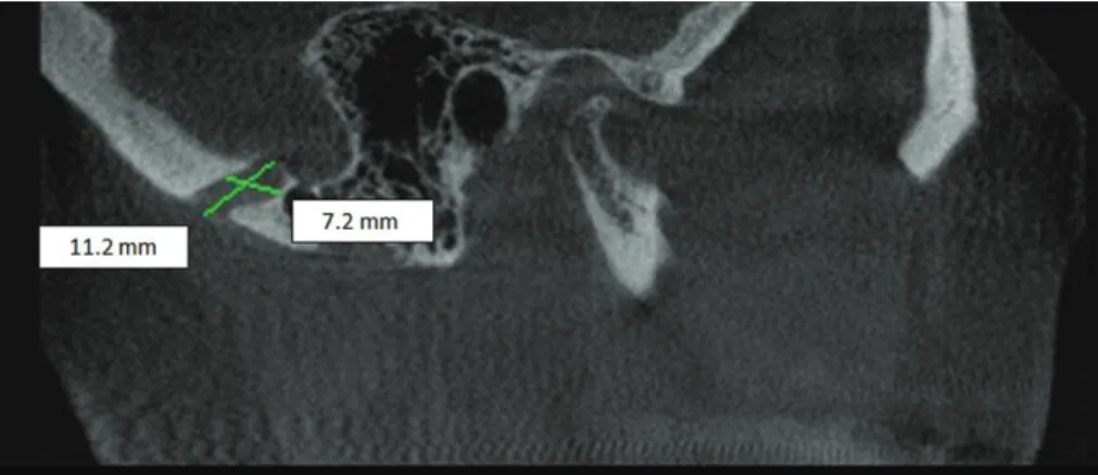 Fig. 7.  Intracranial side of the right mastoid foramen (arrow). Note 