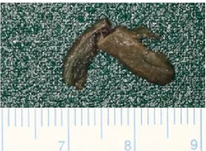 Fig. 5. Foreign body in the left pyriform sinus tract.