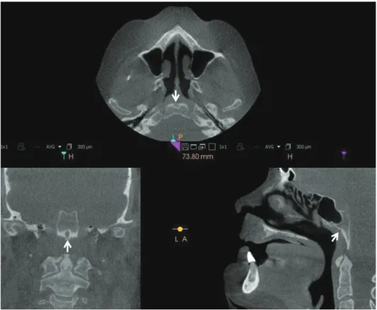 Fig. 4.  Axial, coronal, and sagittal  images in case 4 show a  well-de-fined, round osseous defect noted  in the inferior aspect of the clivus,  radiographically consistent with  fossa navicularis magna.