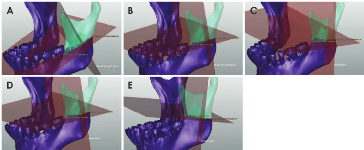 Fig. 3.  Five vertical planes are used as reference planes for measuring the horizontal distance from the anterior ramus to the mandibular  foramen (MnF)