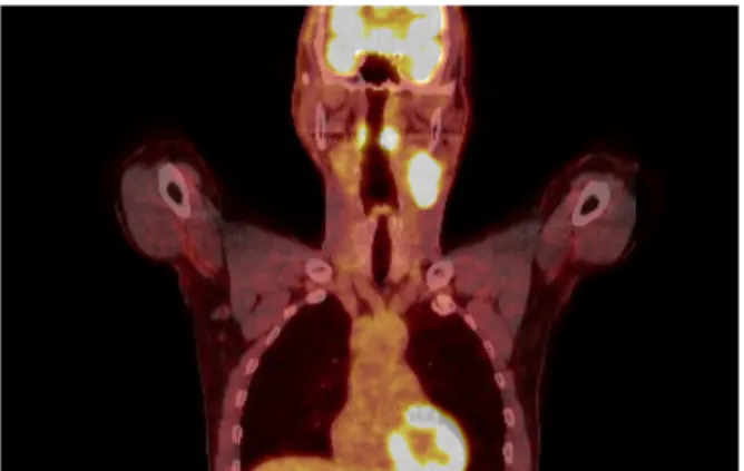 Fig. 1. Axial contrast enhanced computed tomography. image shows 3.7×3.0 cm sized left palatine tonsil(*)(A)