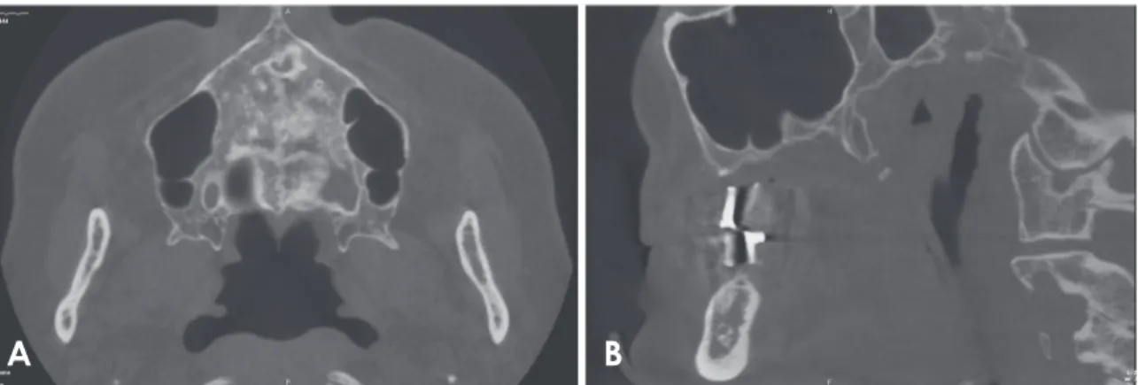 Fig. 1.  Septa are seen on an axial (A) and coronal (B) section images.