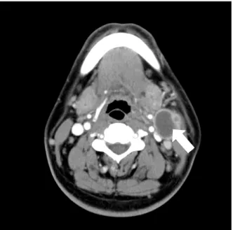 Fig. 2. Specimen from 1st Operation (Excisional biopsy). 2.8 x  2cm sized cystic mass and 2 x 2cm sized lymph node (A) and  other enlarged lymph node(B) was retrieved
