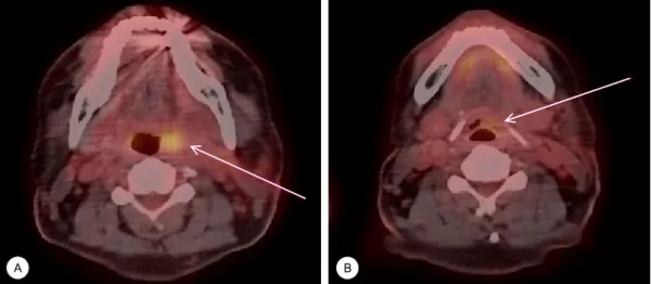 Fig. 4. Fields of 2nd Operation after confirmed diagnosis. (A) operation field of modified radical neck dissection(left neck level I,II,III,IV  and V) (B) Field of intraoral wide excision of Tonsil fossa.