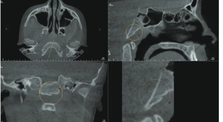 Fig. 1.  Multiplanar reconstruction images demonstrate a defect on the basiocciput of the clivus consistent with canalis basilaris medianus  in an 11-year-old female.