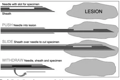 Fig. 1. Illustration of core needle biopsy.