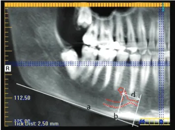 Fig. 2.  Visualization of the anterior loop and incisive canal (red  dotted line) on the panoramic reconstructions