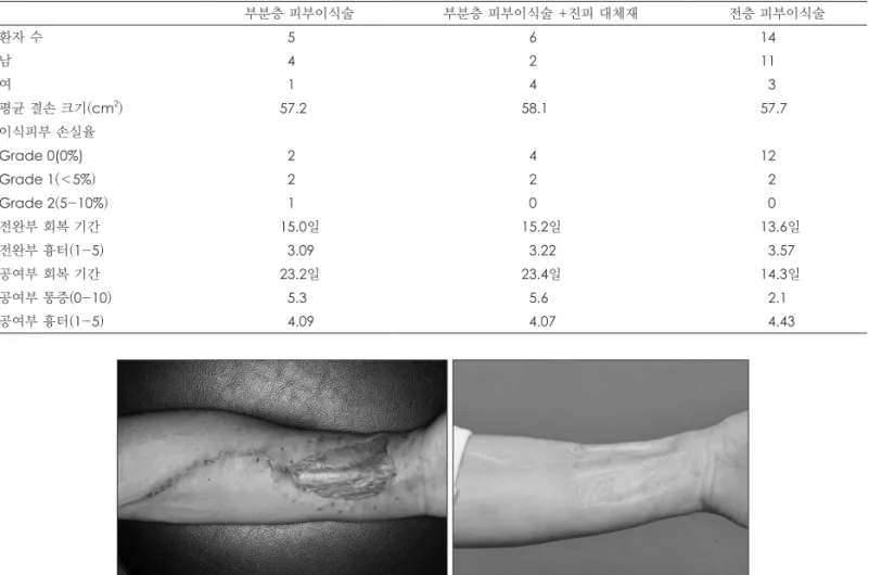 Fig. 1. Comparison radial forearm free flap donor site between split thickness skin graft(Left) and full thickness skin graft(Right).