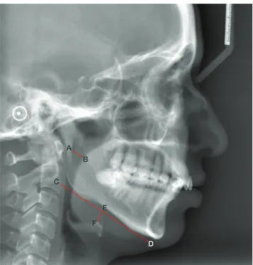 Fig. 1.  Lateral cephalogram shows the upper the upper airway  diameter (A-B); the mandibular plane (tangent drawn to the  man-dibular plane: C-D), and the distance from the manman-dibular plane to  the hyoid bone (E-F).