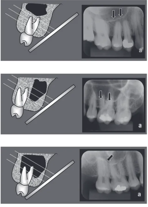 Fig. 2.  Maxillary sinus with pneuma- pneuma-tization near the root of the maxillary  molar
