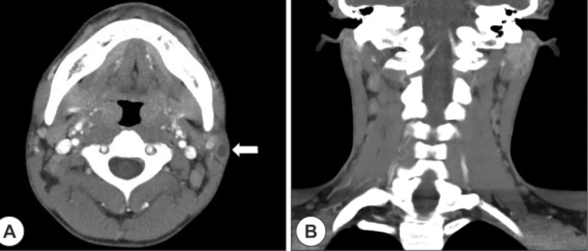 Fig. 1. Neck CT with enhanced image. A : Axial view. Mass with cystic component is noted at left parotid and variable sized enlarged  lymph nodes were noted at left level II