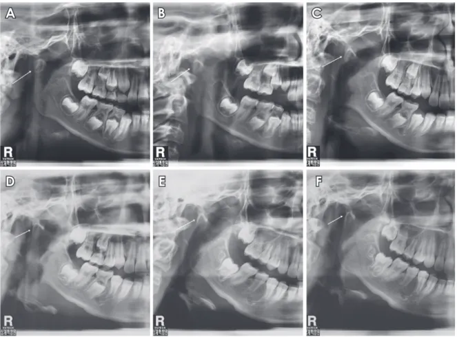 Fig. 3.  Panoramic radiographs reveal the remodeling process of the fractured right condylar head at 6­month intervals