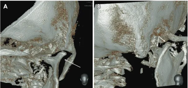 Fig. 5.  Three­dimensional reconstructed images show bifid mandibular condyle (BMC) formation