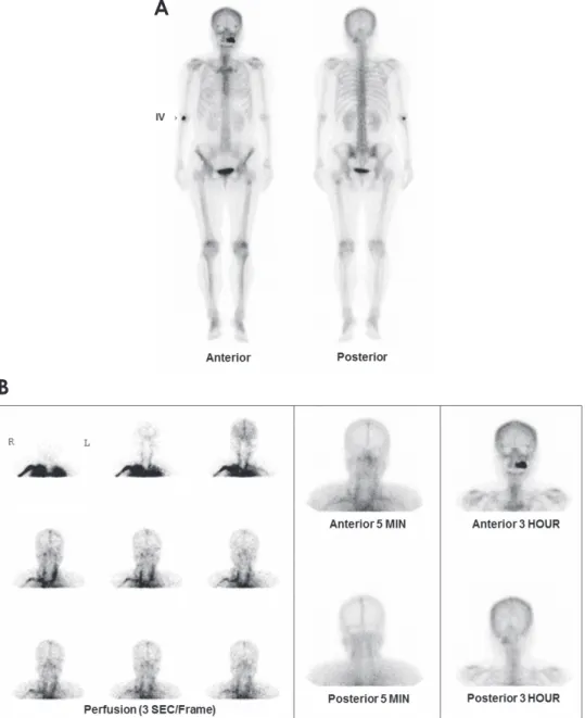 Fig. 5.  A. A whole-body bone scan (2008) shows intense uptake of radioisotope in the left maxilla