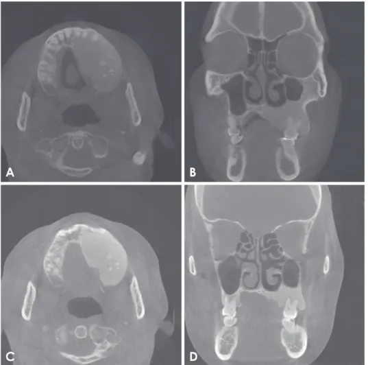 Fig. 7.  Cone-beam computed to- to-mography images (A and B, 2016)  show a similar image and no change  in size, compared with the 2012  image (C and D)