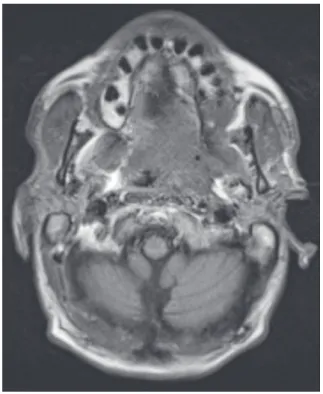 Fig. 3.  T1­weighted axial magnetic resonance imaging shows the  extension of abnormal soft tissue to the left parapharyngeal space,  with no separation from the left masticator space and muscles,  specifically the pterygoid and masseter muscles