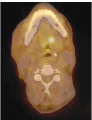Fig. 9.  A positron emission tomography­computed tomography  image shows a hypermetabolic mass centered on the left naso­oro­