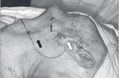 Fig. 1. Lateral photograph of incision design ; 5×3 cm sized  fixed mass on left preauricular area(white arrow) and 3 cm  sized palpable solid mass at neck level II(black arrow).