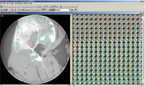 Fig. 1. Segmentation process with 3D Doctor