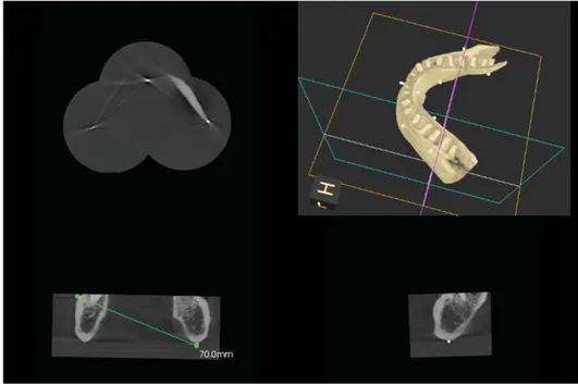 Fig. 2. A Stitched image using the small field of view cone-beam  com-puted tomography images is seen.