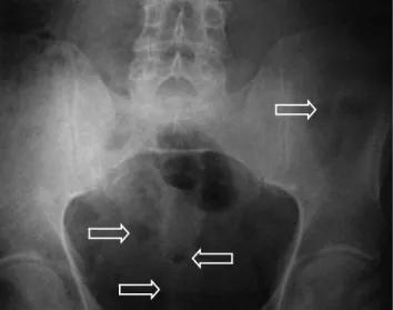 Fig. 4. An antero-posterior pelvic radiograph shows multiple punchedout radiolucent lesions.