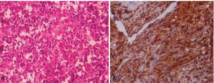 Fig. 6. Photomicrographs show the proliferating sheets of atypical plasma cells (A, H&amp;E stain, 200×) and the immunohistochemically positive cells for CD138 (B, 200×).