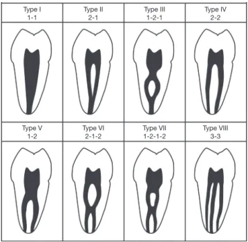 Fig. 1.  Classification of root canal configuration. 1  Type I: a single  canal extends from the pulp chamber to the apex