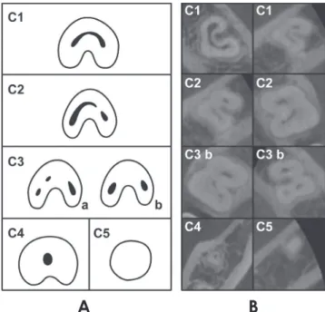 Fig. 3.  Classification of C-shaped canal configurations. 19  A. C1: 