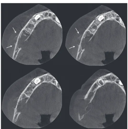 Fig. 2.  Axial cone-beam computed  tomography images show lingual  expansion and perforation of the  buccal and lingual cortical plates