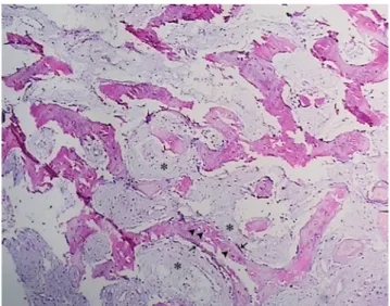 Fig. 5.  Fibrous stroma with fibroblastic cells. Some myxoid chang- chang-es (asterisks) in the stroma, normal bone trabecules containing  osteocyte lacunae (arrowheads), and osteoblastic margins (arrows)  are seen (H&amp;E stain, 100×)
