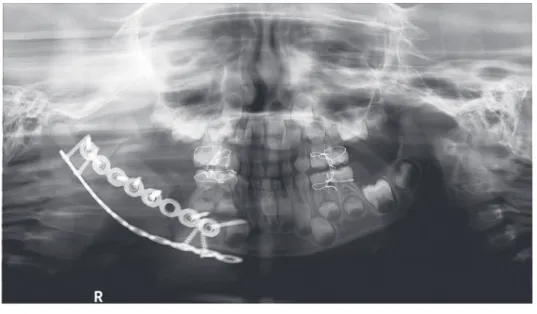 Fig. 6.  Postoperative panoramic  radiograph.