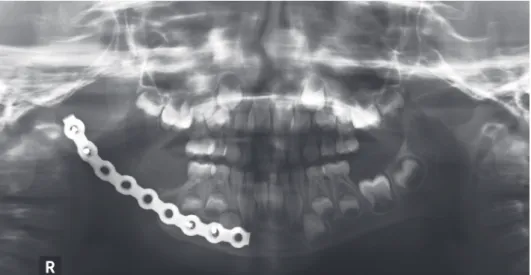 Fig. 8.  A six-month follow-up pa- pa-noramic  radiograph shows the  pa-tient’s stable condition with no  re-currence.