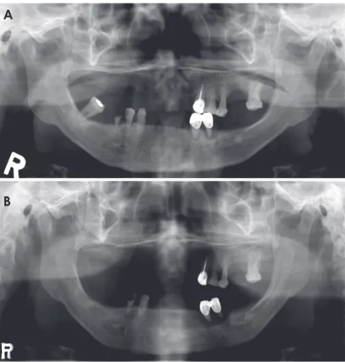 Fig. 2.  A and B. Two panoramic radio- radio-graphs acquired from the same anterior  edentulous patient using a conventional  chin-support device show lack of  repro-ducibility in the inter-maxillary vertical  dimension.