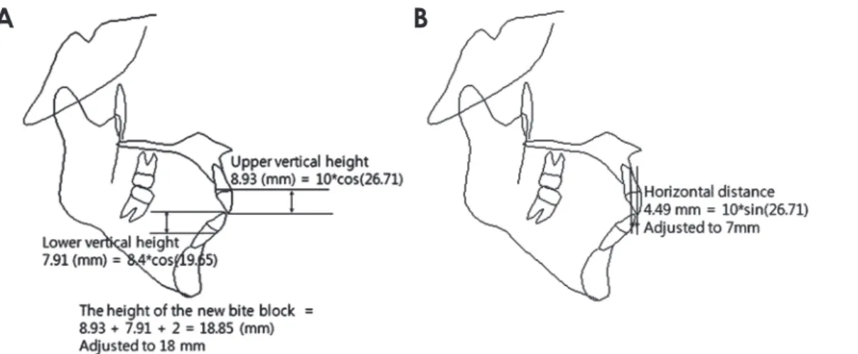 Fig. 4.  A. The calculation to determine the height of the new bite block. B. The horizontal distance calculation to determine the antero-pos- antero-pos-terior dimension of the new bite block.