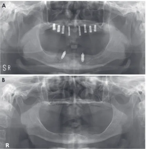 Fig. 6.  A and B. The panoramic radio- radio-graphs taken using the new bite block  showed a more suitable vertical height  and antero-posterior position, and better  bilateral symmetry than the panoramic  radiographs taken using the  chin-sup-port device.