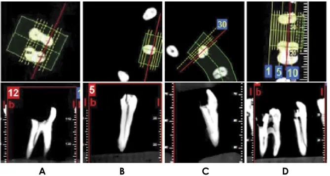 Fig. 1.  Fracture lines in axial and cross-sectional cone-beam computed tomography images