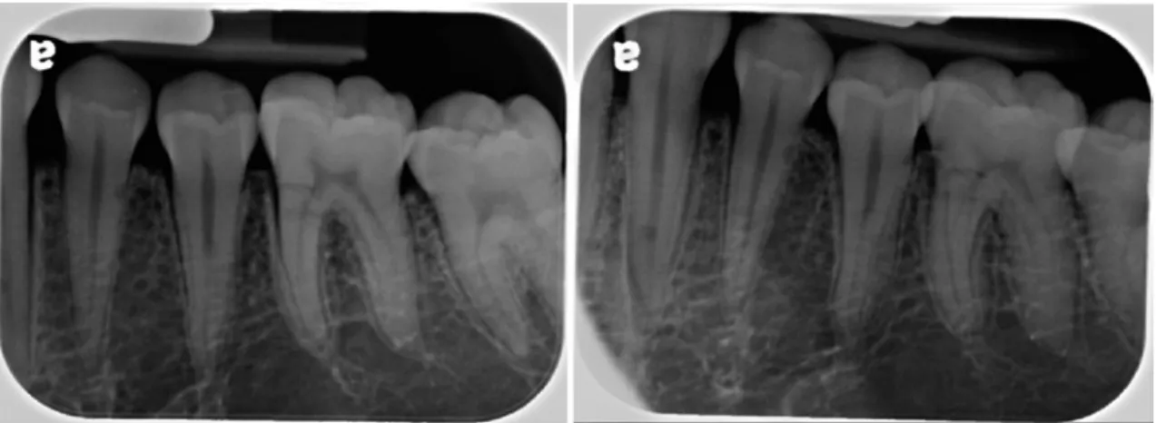 Fig. 3.  A set of orthogonal (PA, left) and corresponding mesioangulated projection (SET, right) are taken.