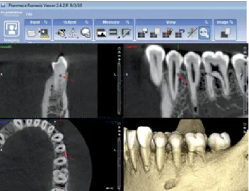 Fig. 4.  Planmeca Romexis Viewer Software shows axial, coronal,  sagittal, and three­dimensional CBCT images of simulated exter­
