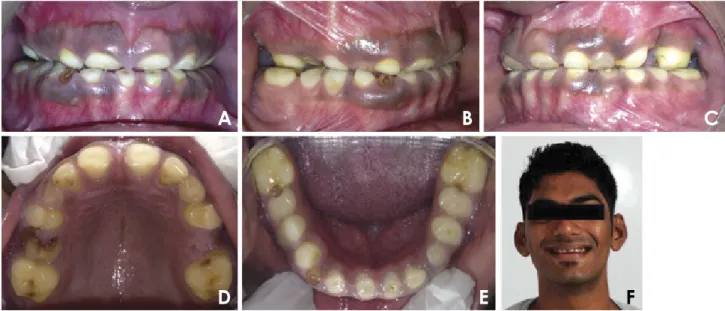 Fig. 1.  A. A frontal view shows pigmented gingiva, the absence of enamel with spacing between the teeth, and a semi­lunar appearance of  the maxillary central incisors