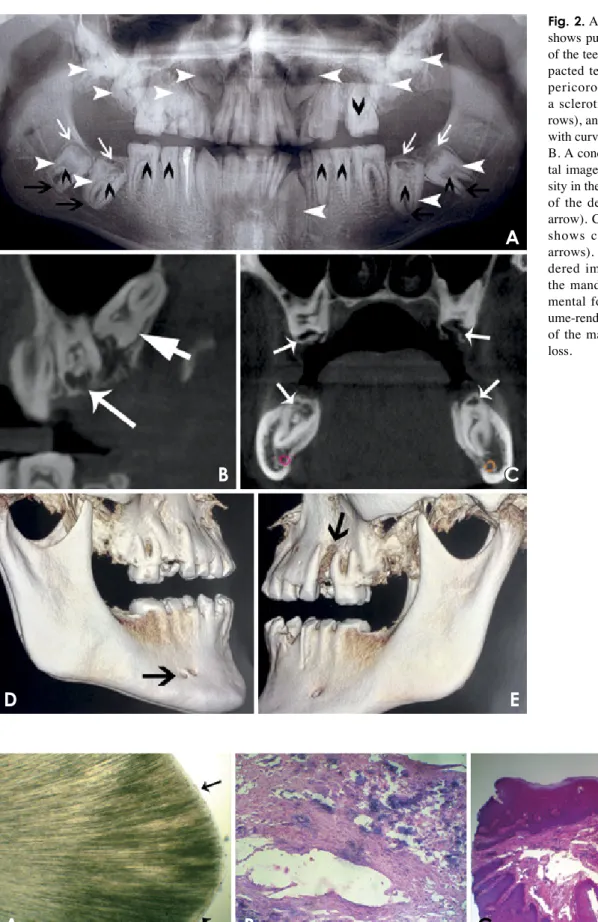 Fig. 3.  A. A photomicrograph of a ground section shows the absence of enamel and scalloping of the dentinoenamel junction (black ar­