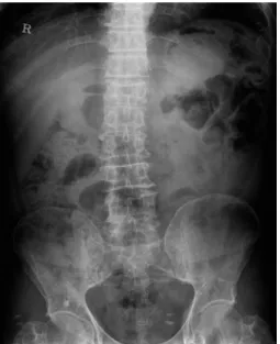 Fig. 4.  At 50 days after extraction, pus discharge from the wound  and sequestra formation are observed.