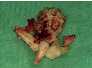 Fig. 6.  A photograph shows the extracted premolars, the first mo- mo-lar, and a necrotized bone fragment.