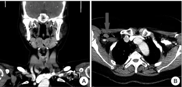 Fig. 1. About 6-cm sized, well defined elongated soft tissue density lesion(arrow) at right axillary fossa : Axillopectoral muscle(Langer’s axil- axil-lary arch) on cononal view(A) and axial view(B).