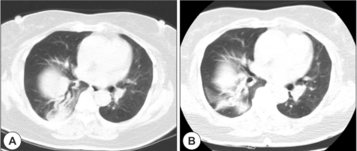 Fig. 2. A : Computerized tomography of the chest at 2 months after surgery. B : 9 months after surgery