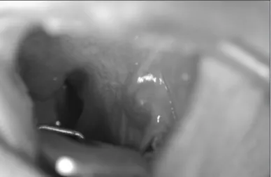 Fig. 1. The external photography shows 1.5×1 cm sized bluish mass  in retromolar trigone.