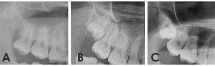Fig. 2.  Classification of the available retromolar space on panora­