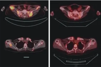 Fig. 5. Transverse sections of PET-CT(positron emission tomogra- tomogra-phy-computed tomography) scan at Brown tumor(preop and  postop)